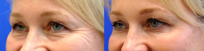 Botox kırışıklık tedavisi